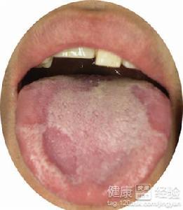 舌炎一個多月了沒有好怎麼辦