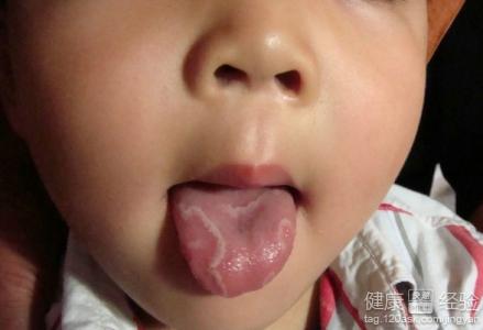 舌炎是怎麼回事，舌炎的原因是什麼