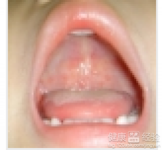 容易的口腔潰瘍和舌炎，怎樣才能改善