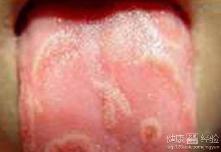 舌炎可以用西瓜霜噴霧嗎