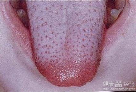更年期舌炎要吃維生素B2多長時間