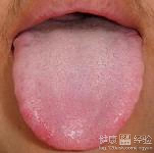 患上舌炎怎麼辦