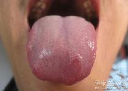 舌頭上起泡該怎麼辦