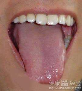 舌頭燙傷怎麼辦