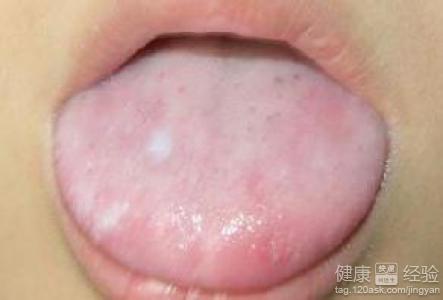 如何預防舌炎