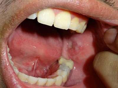 　口腔潰瘍的簡單療法
