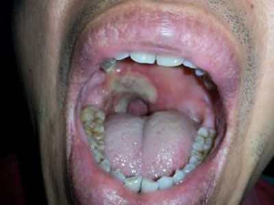 　口腔潰瘍發病的原因及治療的方法