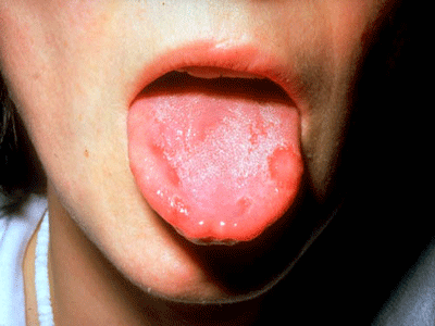 口腔潰瘍用珍珠粉