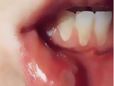 口腔潰瘍有哪些早期症狀？