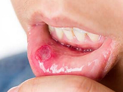 口腔潰瘍切不可輕視 提前預防避免癌變