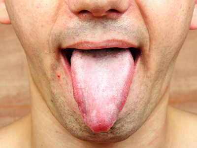 　經常口腔潰瘍是什麼原因?