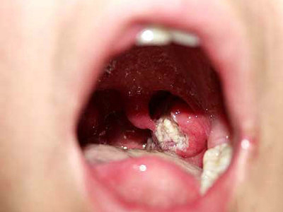 　口腔潰瘍久治不愈的危害有哪些呢?