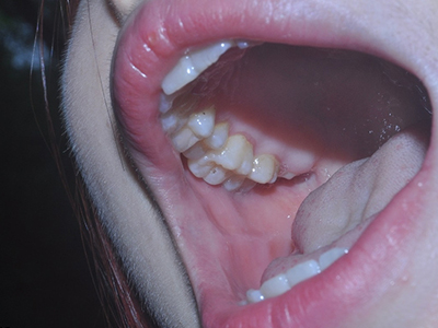 　　得了口腔潰瘍怎麼辦？口腔潰瘍怎麼刷牙？