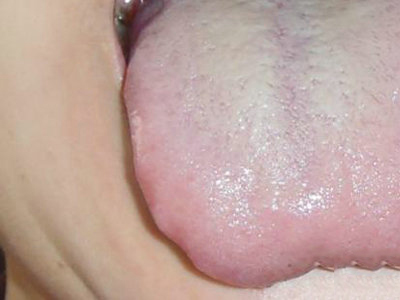 口腔潰瘍與口腔癌的關系