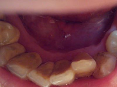 口腔潰瘍口腔白斑可別分不清 其中有一個是癌前病變！