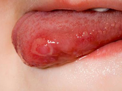 口腔潰瘍太難纏 如何應口腔的潰瘍問題