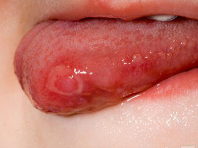 口腔潰瘍與口腔糜爛症狀辨別