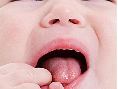 口腔潰瘍的症狀表現是什麼？