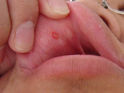 　口腔潰瘍疾病的症狀有哪些呢