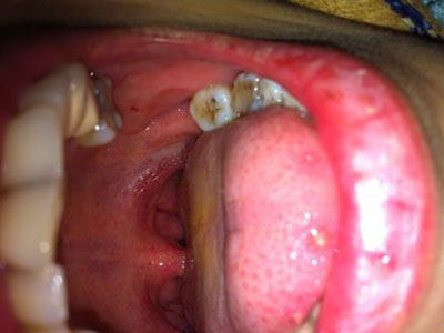 佩戴不合適的假牙托導致口腔潰瘍