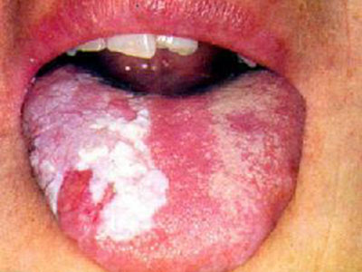 　　口腔潰瘍易與哪些疾病混淆?