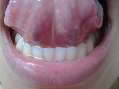 　哪種口腔潰瘍是癌症先兆？