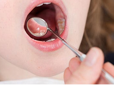 口腔潰瘍會癌變 五種方法幫你辨