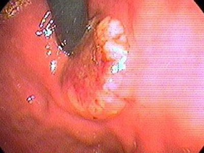 口腔潰瘍——看看你的嘴洞有多大