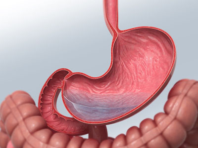口腔潰瘍是否是腸胃問題？