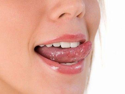 口腔潰瘍的快速治療辦法