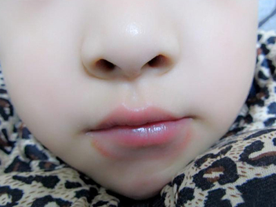 口腔潰瘍為啥老是纏上寶寶？