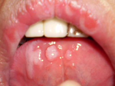 小症狀不一定是小病，口腔潰瘍需重視