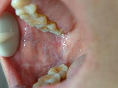 口腔潰瘍究竟是不是病？