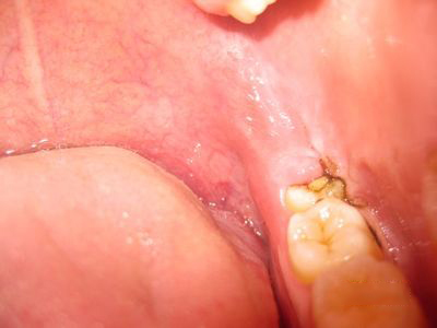 口腔潰瘍位置 揭秘你五髒是否健康