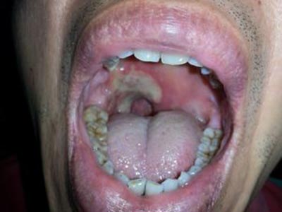 口腔潰瘍與白塞氏綜合症有什麼關系