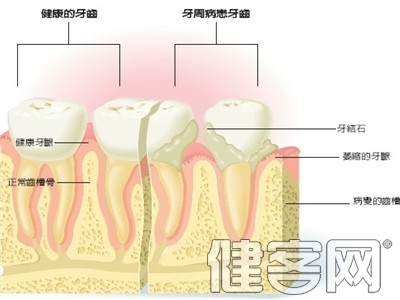 老人口腔潰瘍2個治療偏方