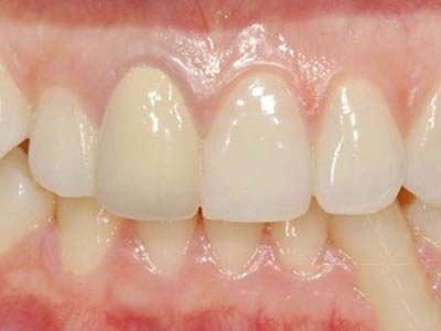 牙痛的處理方法你知道嗎？