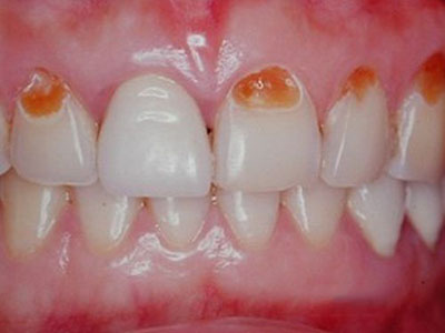 牙疼就一定是上火嗎？！牙科醫師說可能是牙周炎！