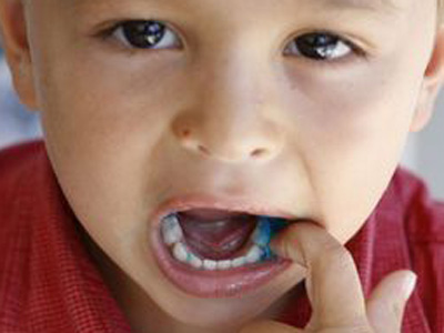 　　專家介紹牙疼的防止辦法：  　　1、假設小孩說牙痛，家長除了能夠直接查詢孩童是不是有齲齒，還能夠用小勺子悄悄叩擊小孩的牙齒，找到哪個牙齒發作了疑問。  　　2、每隔一段時刻，就要看看小孩的牙齒外表有沒有黑點或小洞。每半年要帶孩童去醫院查看牙齒的成長和健康情況。  　　3、往常要糾正小孩不良習氣，培育精確的日子規則，飯後、睡前必定要漱口或刷牙。臨睡前不吃甜食，分外是嬰孩童，不要含著乳頭吃著奶睡覺，較大的孩童要糾正吃零食的習氣。  　　4、小孩出世後6個月擺布乳牙一旦萌出，在哺乳或進食後，家長應把紗布套於食指，幫忙清洗牙面，3歲前後教會濑口，4歲前，由家長監督幫忙小孩刷牙。  　　5、小孩宜選用順刷法，先用刷頭較小，刷毛較軟的小孩保健牙刷，順著牙冠的方向刷牙，能夠刷去牙齒上的食物軟垢，一同對牙根起到<a name='InnerLinkKeyWord' href='http://www.jianke.com/zypd/zyts/tnam/' _fcksavedurl='http://www.jianke.com/zypd/zyts/tnam/' target='_blank'>按摩</a>效果。往常要運用含氟的牙膏刷牙。由於運用含氟牙膏刷牙，使牙齒外表掩蓋一層氟化物，牙齒就能對立細菌和糖對牙齒的腐蝕。  　　溫馨提示您：孩童長牙齒期間，假設不能做好孩童的口腔養護保健，很簡略會牙疼。母親們往常應當先去了解孩童保健方面常識，活潑做好防止孩童牙疼的保健辦法，盡量防止孩童呈現牙疼表象。