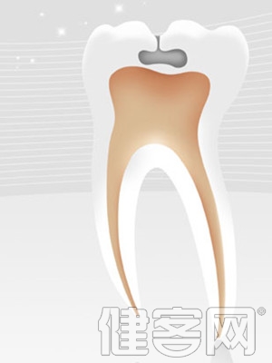 齲齒等6大原因導致牙痛不止
