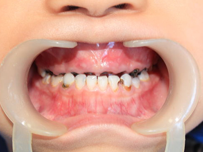 什麼是齲齒 齲齒的危害是什麼？