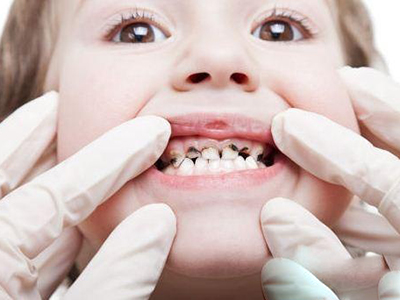 刷牙+“窩溝封閉”——預防兒童口腔齲齒雙保險