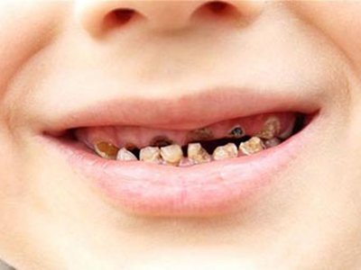 兒童齲齒怎麼治療？治療方法在這裡！