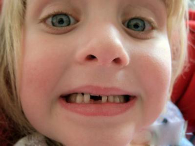 兒童齲齒的預防與早期治療？
