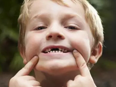 兒童蛀牙的預防妙招你知道嗎？