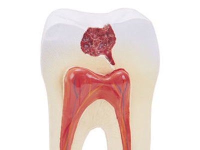 　蛀牙怎麼辦四個方法幫你治療