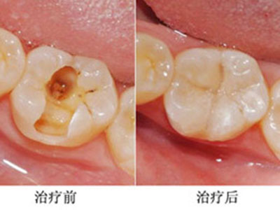 非創傷性充填技術在齲齒治療中的應用