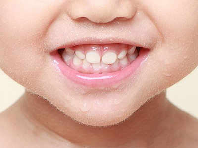 兩歲女嬰牙齒變黑 原因竟長期含奶瓶致齲齒