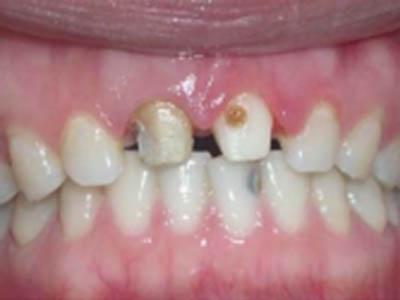 　　齲齒與牙齒質量有什麼關系