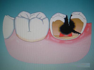 窩溝封閉預防齲齒
